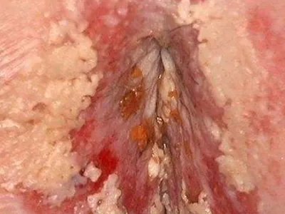 外阴阴道假丝酵母菌病豆腐渣白带图片