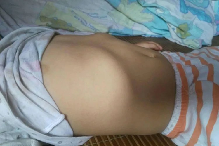 小孩平躺肋骨外翻图片