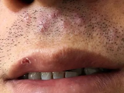 毛囊炎疙瘩图片