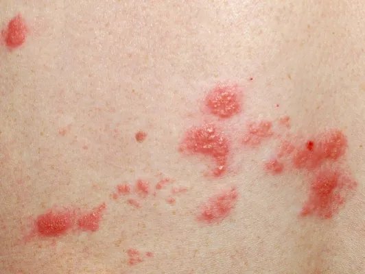 带状孢疹的症状