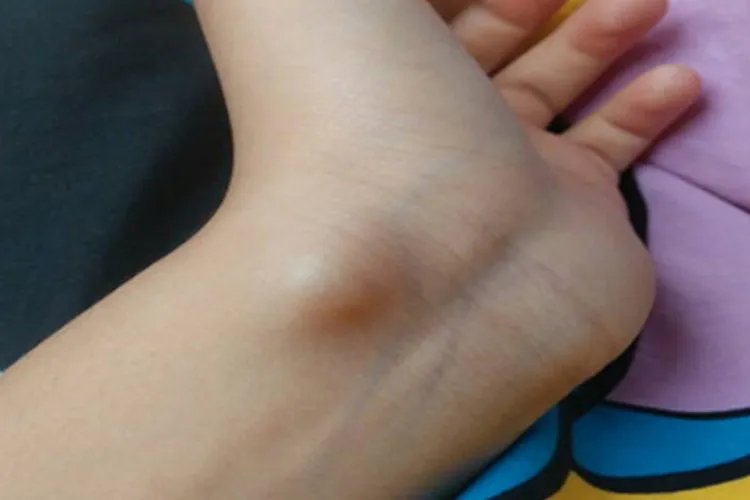 儿童腱鞘囊肿图片