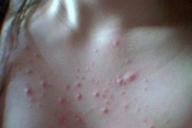 胸口长小肉粒图片