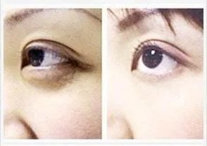 北京激光去眼袋医院哪家好?