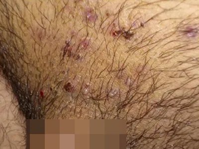 毛囊炎疙瘩图片