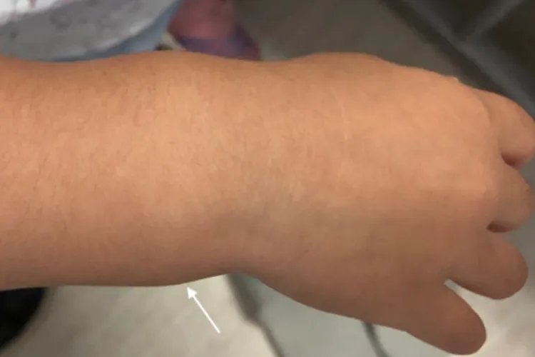 佝偻病儿童图片