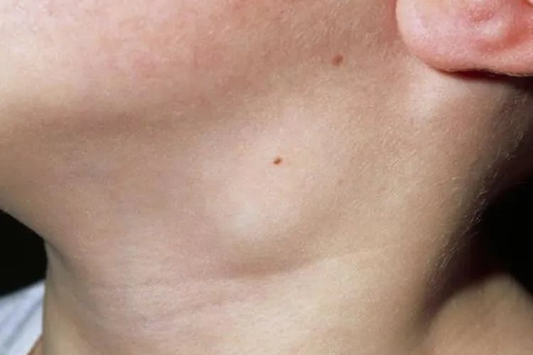 幼儿脖子淋巴结肿大图片