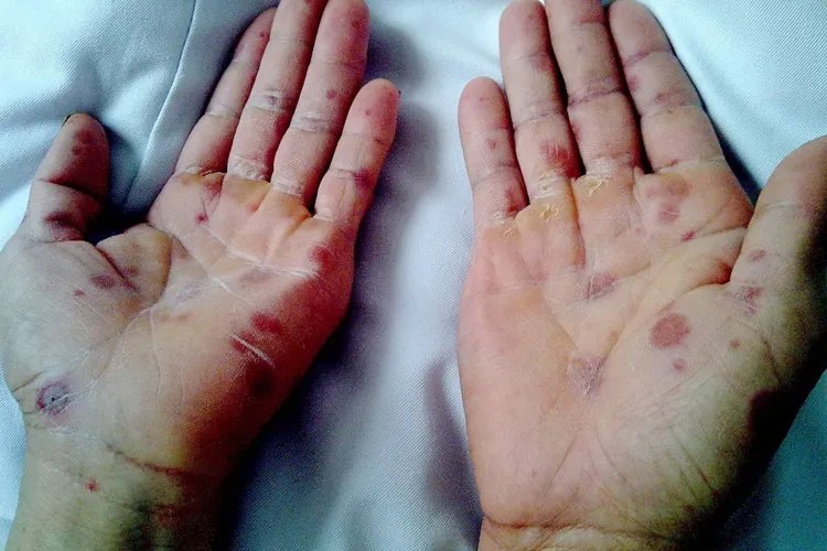 多形红斑好转的顺序图片