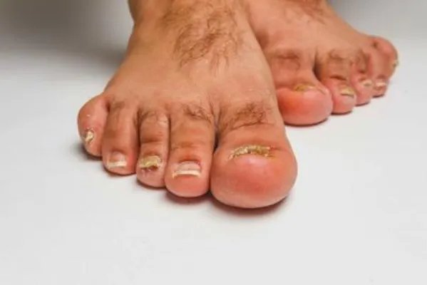 治疗灰指甲民间偏方有哪些 有效的偏方推荐