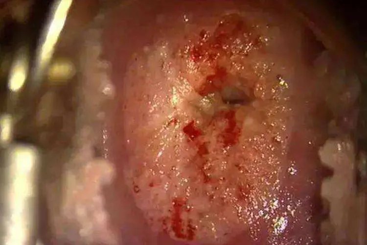 宫颈癌和正常宫颈图片