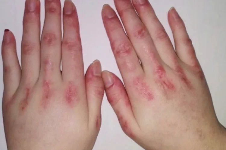 皮囊炎症状及图片