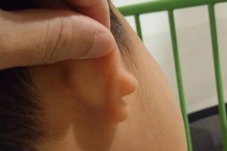 先天性耳朵畸形图片