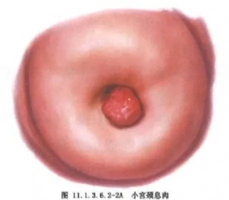 宫颈息肉图片大全