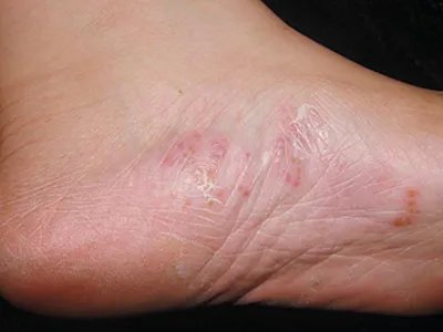 水疱型足癣脚部水疱图片