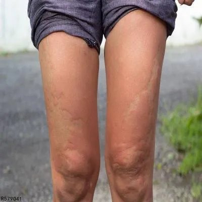 季节性荨麻疹有什么危害