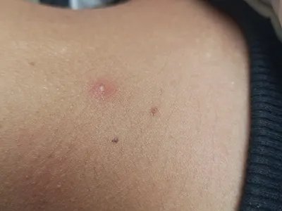 毛囊炎疙瘩图片