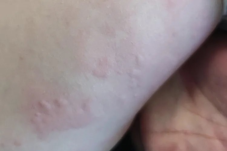 吃螃蟹过敏的症状图片