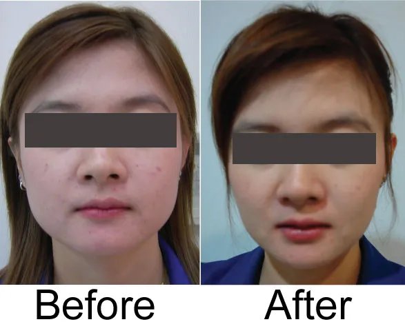 西安瘦脸针多少钱一次