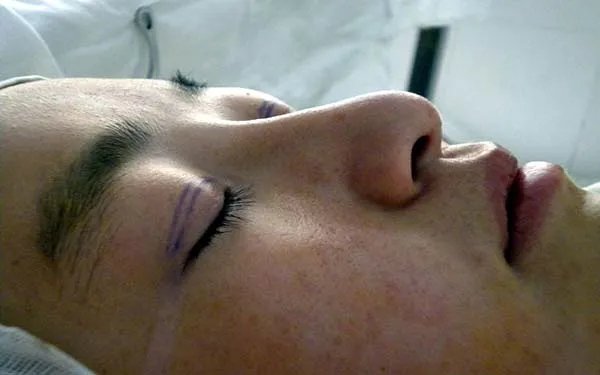 北京做双眼皮好的医院在哪里?