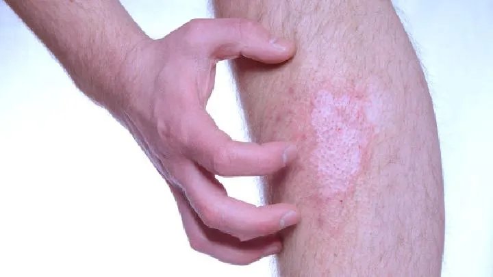 患有体癣会传染吗