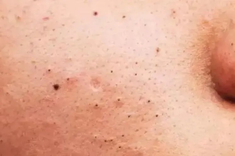 黑头一般长在哪些部位