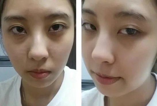 北京激光去眼袋医院哪家好?