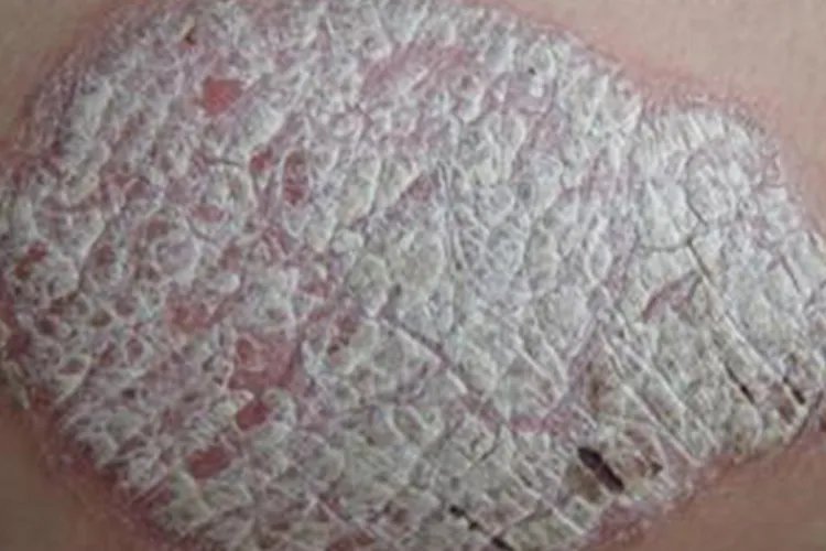 孩子得了牛皮癣图片