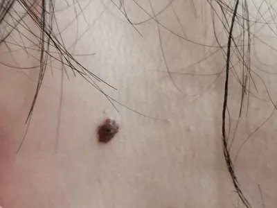 皮内痣黑痣图片