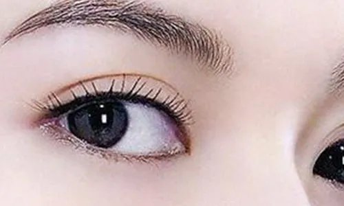 北京割双眼皮的价格大概是多少啊