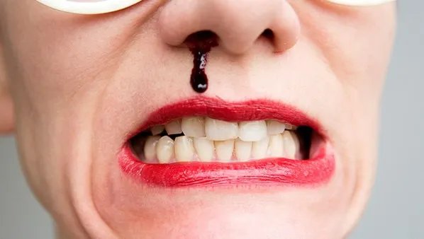 流鼻血止不住怎么办