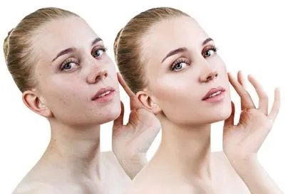 祛白酊能否抹脸上白癜风