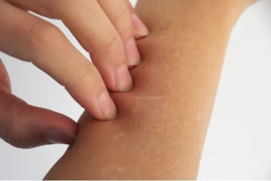 玫瑰糠疹传染吗