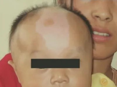 斑驳病头部症状图片