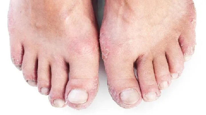 少年脓疱型银屑病检查项目有哪些