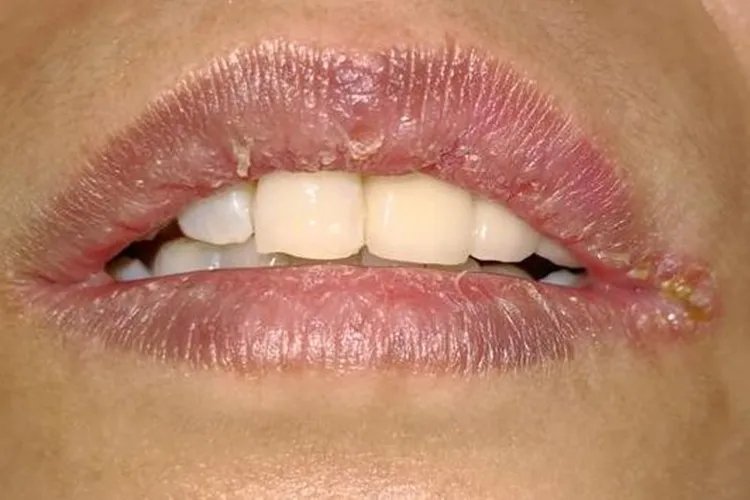 口腔白色念珠菌感染图片