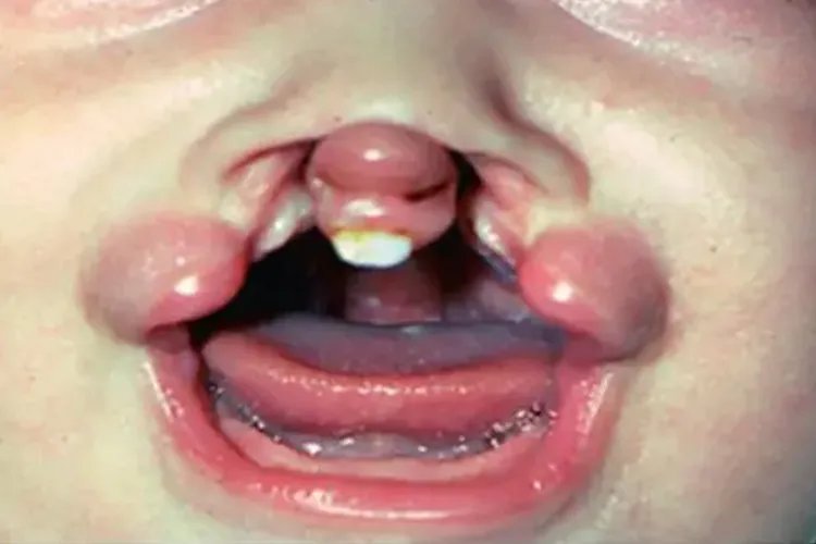 三度唇腭裂图片