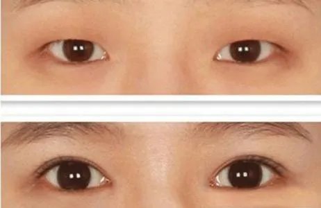 韩式双眼皮好不好