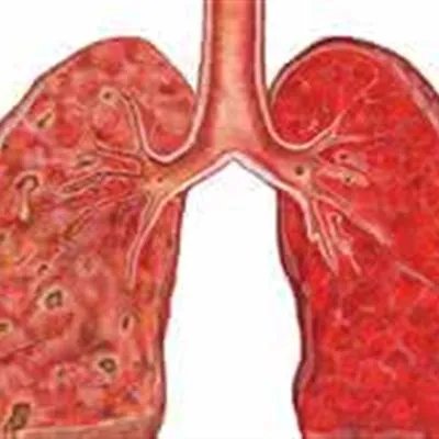 放射性肺炎有什么症状