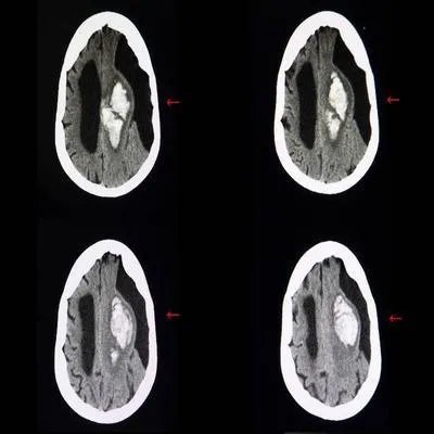 坏死性脑病怎么引起的