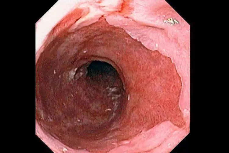 反流性食管炎症状表现