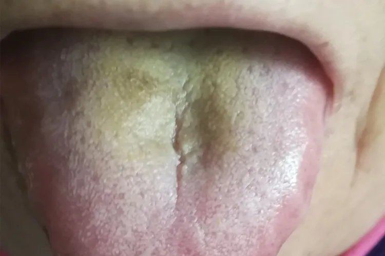 舌苔发黄图片