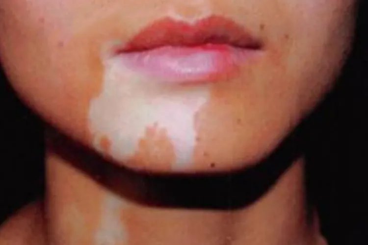 脸部白癜风图片