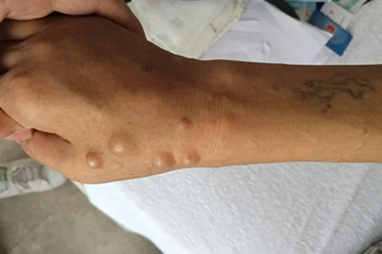 纤维瘤图片辨别