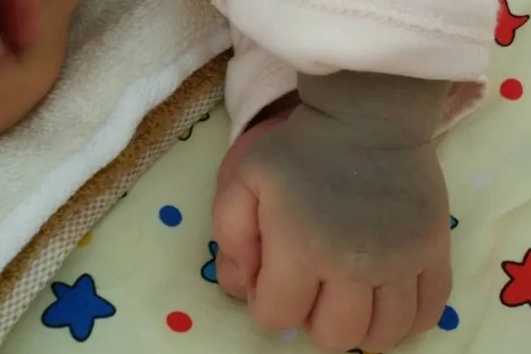 婴儿各种胎记图片