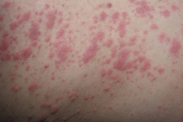 人被螨虫咬的症状图片