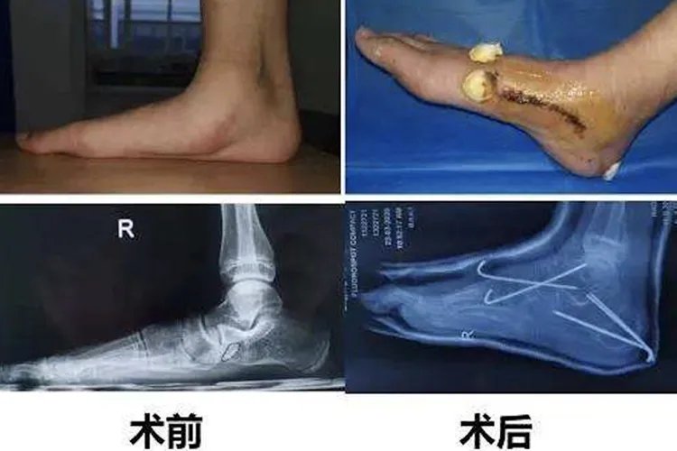 扁平足的矫正方法图解