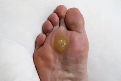 什么是胼胝图片大全