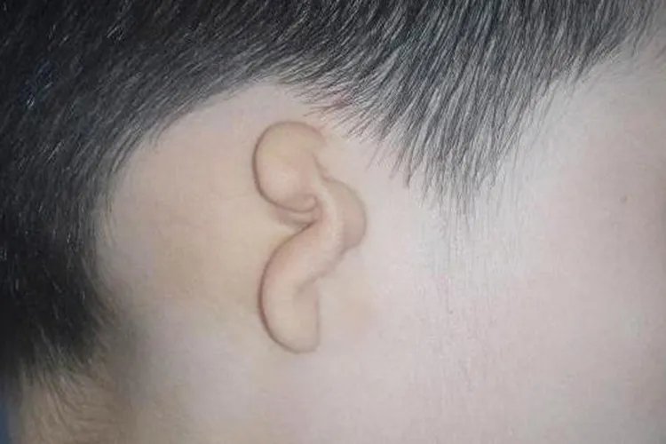先天性耳朵畸形图片