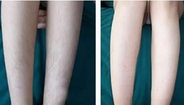 e光冰点脱毛费用