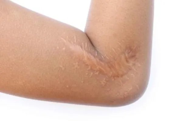 疤痕性体质是什么样的 疤痕体质的症状特点为你讲述