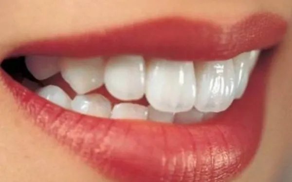 正畸牙齿的年龄限制